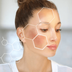 MELASMA